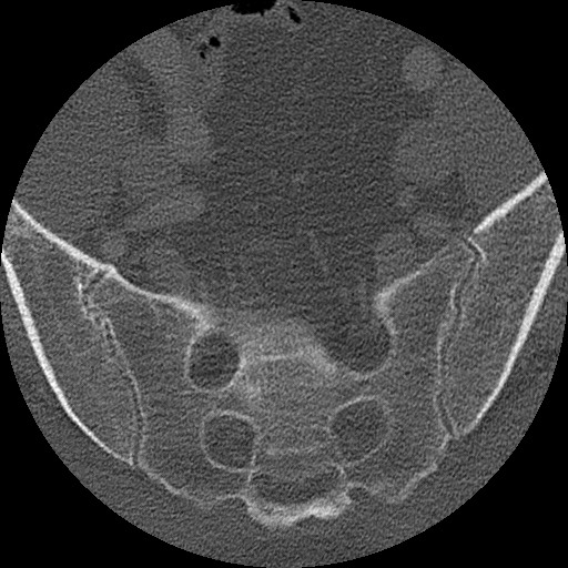 Benign post-traumatic pseudopneumoperitoneum (Radiopaedia 71199-81495 Axial bone window 298).jpg