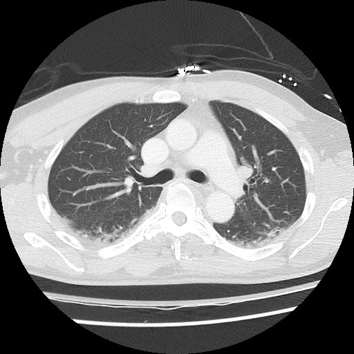 Benign post-traumatic pseudopneumoperitoneum (Radiopaedia 71199-81495 Axial lung window 32).jpg