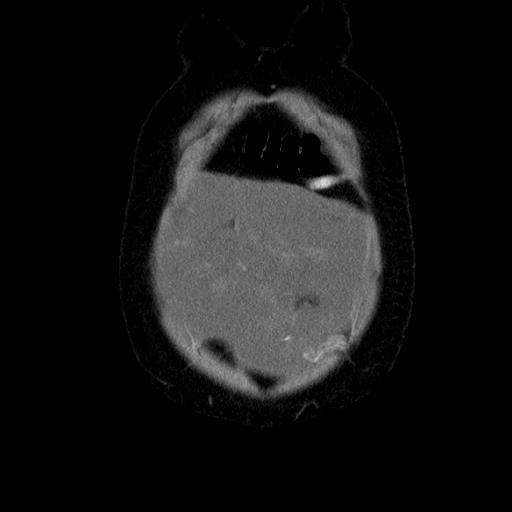 File:Benign spindle cell tumor - abdominopelvic (Radiopaedia 61300-69212 C 9).jpg