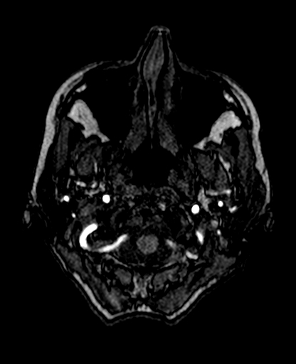 Berry aneurysm of the terminal internal carotid artery (Radiopaedia 88286-104918 Axial TOF 35).jpg