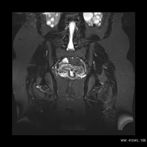 File:Bicornuate uterus- on MRI (Radiopaedia 49206-54297 Coronal STIR 13).jpg
