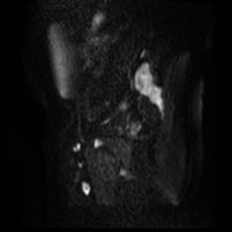 File:Bicornuate uterus (Radiopaedia 51676-57472 Sagittal DWI 45).jpg