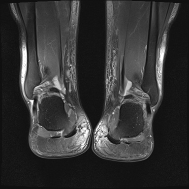 File:Bilateral Achilles tendon complete tear (Radiopaedia 81344-95051 Coronal PD fat sat 5).jpg
