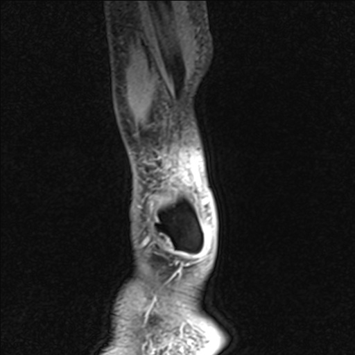 Bilateral Achilles tendon complete tear (Radiopaedia 81344-95051 Sagittal WE - Left 101).jpg