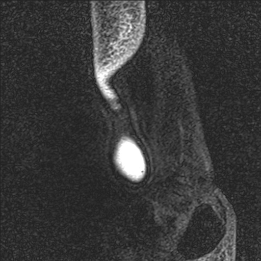 File:Bilateral Achilles tendon complete tear (Radiopaedia 81344-95051 Sagittal WE - Left 111).jpg