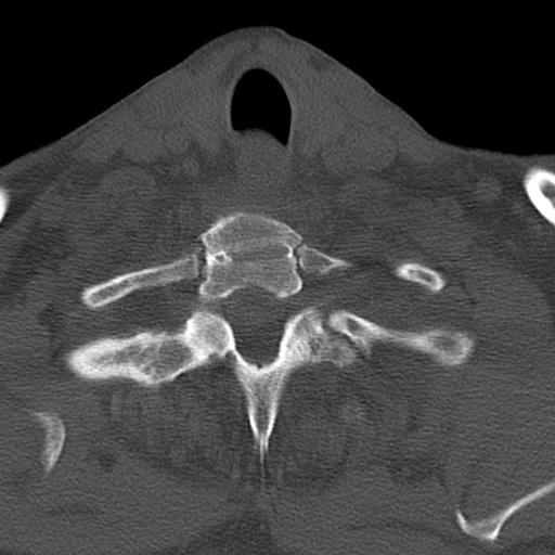 File:Bilateral C6-7 locked facet dislocation (Radiopaedia 28506-28748 Axial bone window 35).jpeg