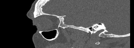 Bilateral Ectopic Infraorbital Nerves (Radiopaedia 49006-54084 Sagittal bone window 45).jpg