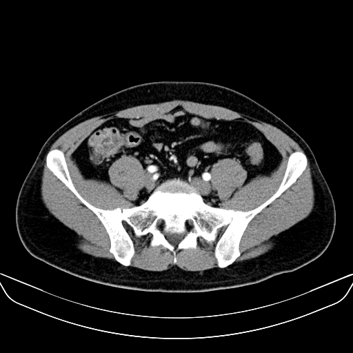 File:Bilateral accessory renal arteries with mild pelvi-ureteric junction (PUJ) obstruction (Radiopaedia 66357-75596 A 50).jpg