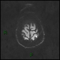 File:Bilateral acute middle cerebral artery territory infarcts (Radiopaedia 77319-89402 Axial DWI 46).jpg