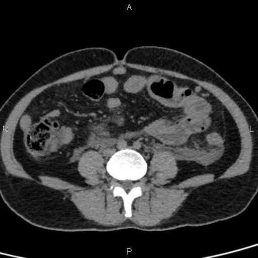 Bilateral adrenal gland hyperenhancement in pancreatitis (Radiopaedia 86642-102753 Axial non-contrast 72).jpg