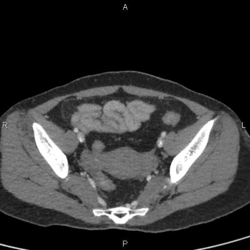 Bilateral adrenal gland hyperenhancement in pancreatitis (Radiopaedia 86642-102753 E 94).jpg
