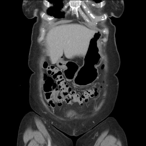 Bilateral adrenal granulocytic sarcomas (chloromas) (Radiopaedia 78375-91007 B 23).jpg