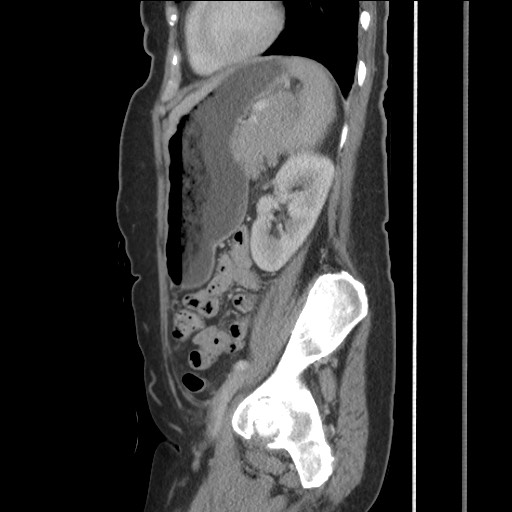 Bilateral adrenal granulocytic sarcomas (chloromas) (Radiopaedia 78375-91007 C 97).jpg