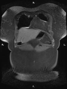 Bilateral adrenal myelolipoma (Radiopaedia 63058-71537 Coronal T1 fat sat 95).jpg