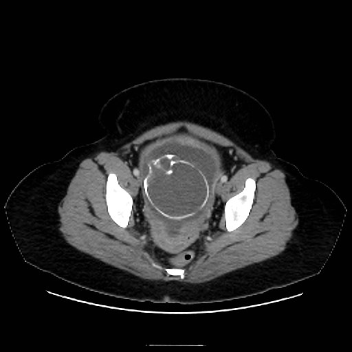 Bilateral adrenal thrombosis (Radiopaedia 58182-65256 A 69).jpg
