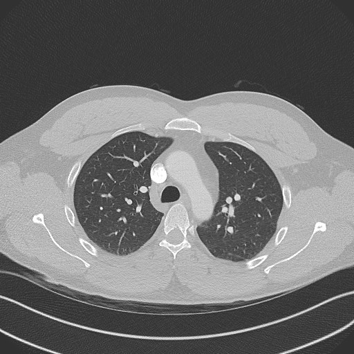 File:Bilateral atelectasis (Radiopaedia 48666-53675 Axial lung window 36).jpg