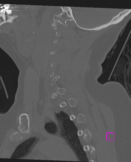 Bilateral atlanto-occipital assimilation (Radiopaedia 28350-28603 Sagittal bone window 23).jpg