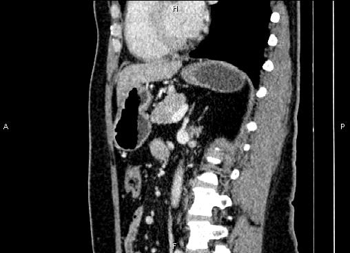 Bilateral benign adrenal adenomas (Radiopaedia 86912-103124 E 59).jpg