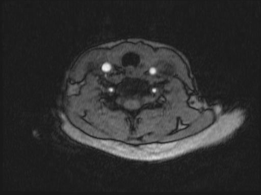 Bilateral carotid body tumors and right glomus jugulare tumor (Radiopaedia 20024-20060 Axial MRA 214).jpg