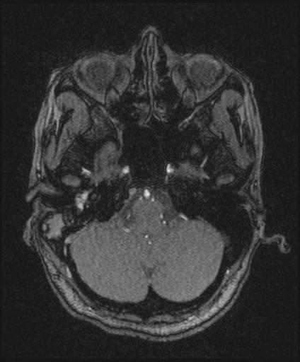 Bilateral carotid body tumors and right glomus jugulare tumor (Radiopaedia 20024-20060 Axial MRA 38).jpg