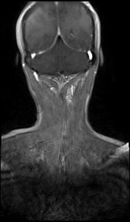 File:Bilateral carotid body tumors and right glomus jugulare tumor (Radiopaedia 20024-20060 MRA 65).jpg