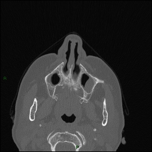 File:Bilateral frontal mucoceles (Radiopaedia 82352-96454 Axial bone window 225).jpg