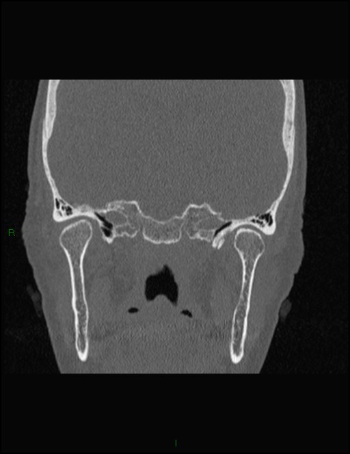 Bilateral frontal mucoceles (Radiopaedia 82352-96454 Coronal 278).jpg