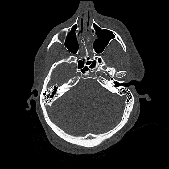 Bilateral occipital condyle fracture (type 2) (Radiopaedia 87675-104089 Axial bone thins 65).jpg
