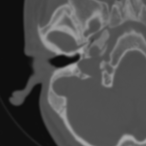 Bilateral otosclerosis (Radiopaedia 57237-64157 B 36).jpg