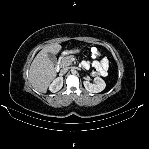 Bilateral ovarian dermoid cysts (Radiopaedia 85785-101603 A 40).jpg