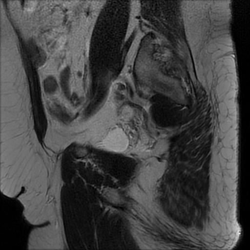 File:Bilateral ovarian dermoid cysts (Radiopaedia 90152-107338 Sagittal T2 6).jpg