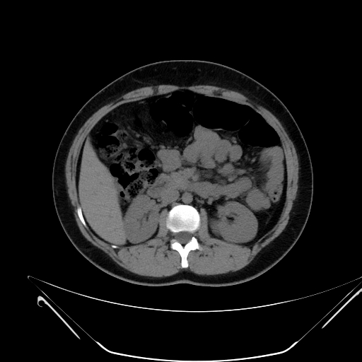 Bilateral ovarian mature cystic teratomas (Radiopaedia 79373-92457 Axial non-contrast 20).jpg