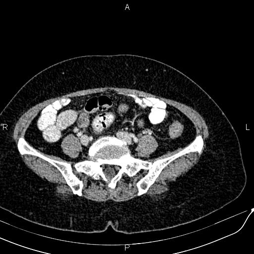 Bilateral ovarian serous cystadenocarcinoma (Radiopaedia 86062-101989 B 72).jpg