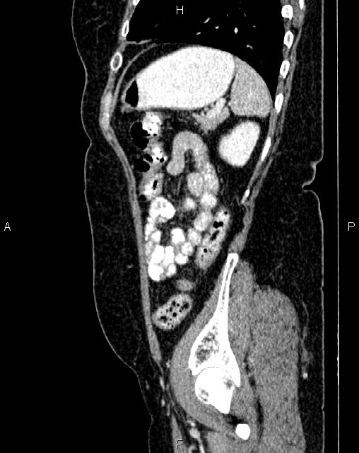 Bilateral ovarian serous cystadenocarcinoma (Radiopaedia 86062-101989 E 70).jpg
