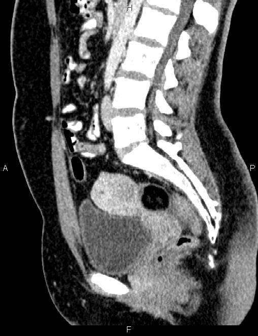 Bilateral ovarian teratoma (Radiopaedia 83131-97503 D 64).jpg