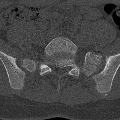 Bilateral pars defect (Radiopaedia 26691-26846 Axial bone window 70).jpg