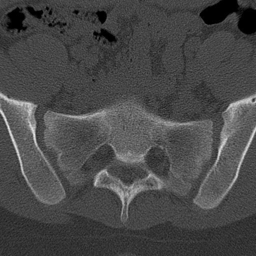 Bilateral pars defect (Radiopaedia 26691-26846 Axial bone window 89).jpg