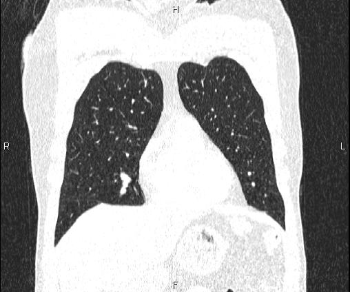Bilateral pulmonary AVM (Radiopaedia 83134-97505 Coronal lung window 27).jpg