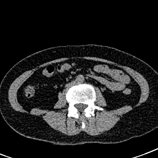 Bilateral staghorn calculi (Radiopaedia 59475-66842 Axial non-contrast 40).jpg