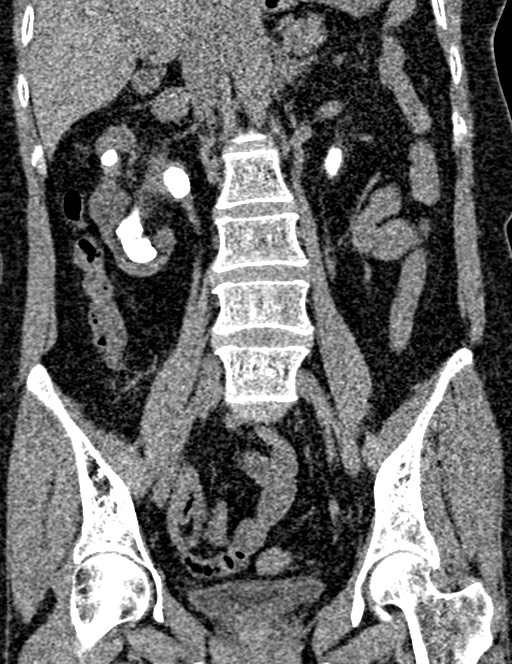 Bilateral staghorn calculi (Radiopaedia 59475-66842 Coronal non-contrast 61).jpg
