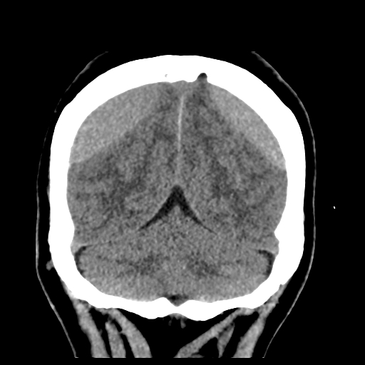 Bilateral subacute subdural hematoma (Radiopaedia 69240-79018 Coronal non-contrast 46).jpg