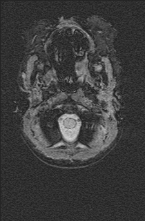 Bilateral subdural hemorrhage and parietal skull fracture (Radiopaedia 26058-26190 Axial SWI 1).png