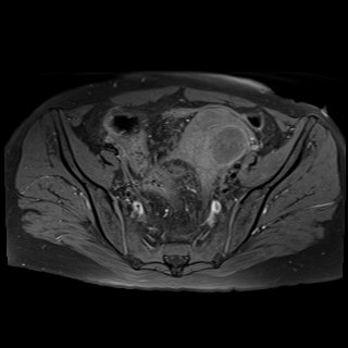 Bilateral tubo-ovarian abscesses (Radiopaedia 58635-65829 Axial T1 fat sat 15).jpg