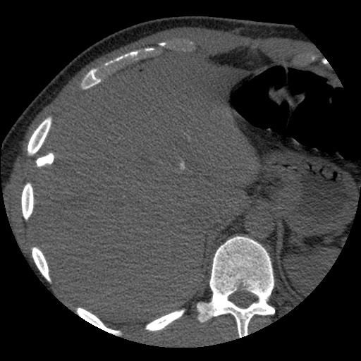Bile leak from liver traumatic laceration (Radiopaedia 63463-72077 Axial Biliscopin 25).jpg