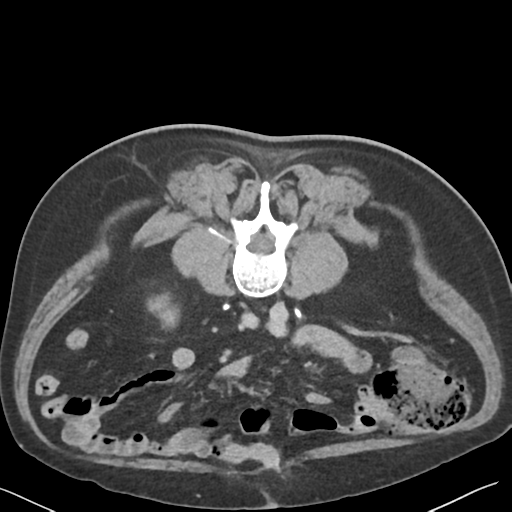 File:Bladder papillary urothelial carcinoma (Radiopaedia 48119-52951 Axial C+ delayed 29).png