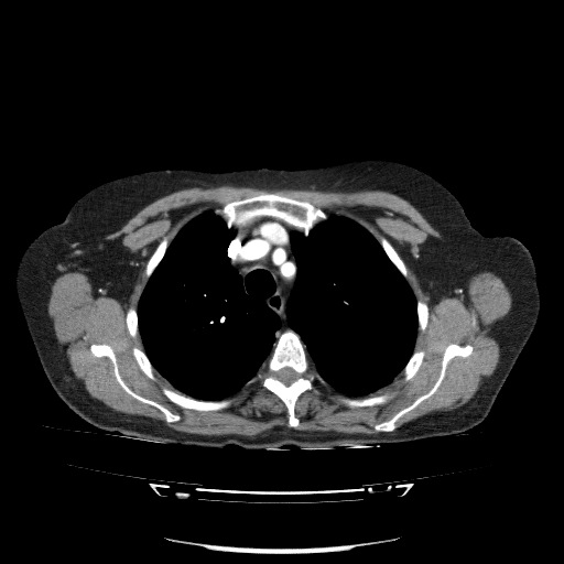 Bladder tumor detected on trauma CT (Radiopaedia 51809-57609 A 27).jpg