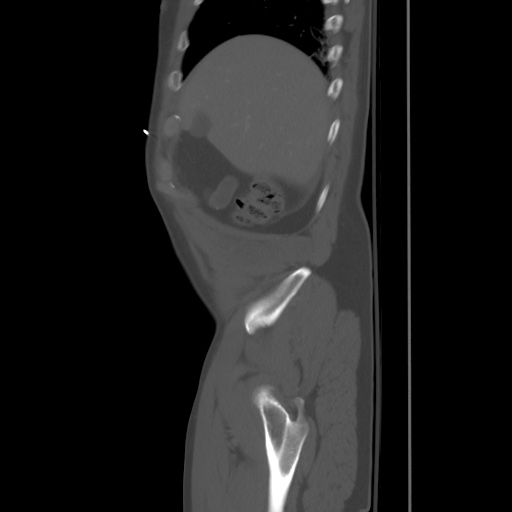 Blunt abdominal trauma with solid organ and musculoskelatal injury with active extravasation (Radiopaedia 68364-77895 Sagittal bone window 8).jpg
