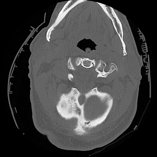 File:Blunt cerebrovascular injury (Radiopaedia 53682-59743 Axial bone window 17).png