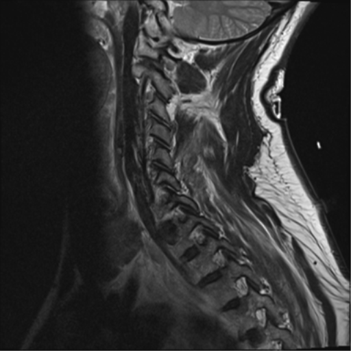 File:Blunt cerebrovascular injury (Radiopaedia 53682-59744 Sagittal T2 3).png