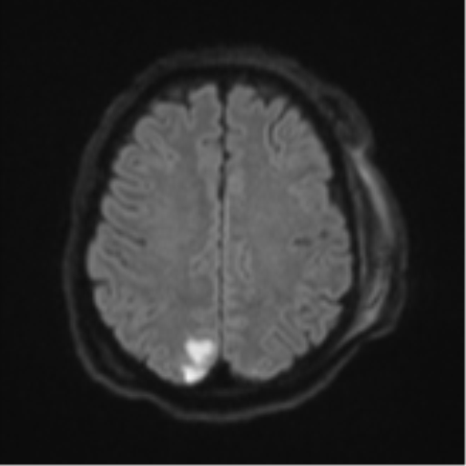 Blunt cerebrovascular injury (Radiopaedia 53682-59745 Axial DWI 52).png